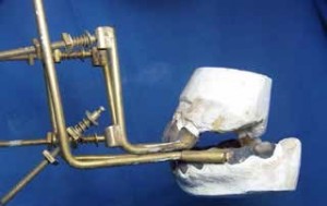 Figure 2. Photograph showing the dental traction appliance with spring mechanisms and threaded screws. The craftsmanship involved in making such a device is particularly noteworthy.